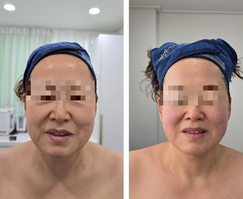 얼굴 관리 전후 비교 사진. 눈 부위는 가려 두었다