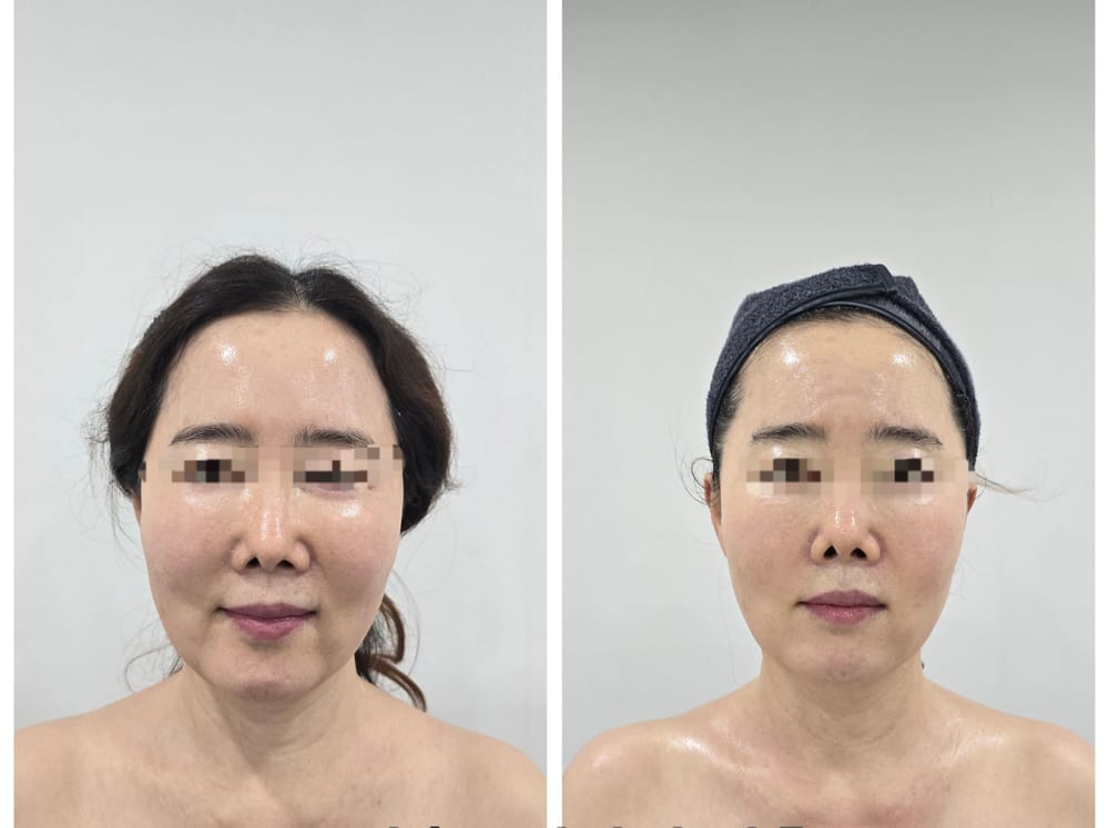 얼굴 관리 전후 비교 사진. 눈 부위는 가려 두었다