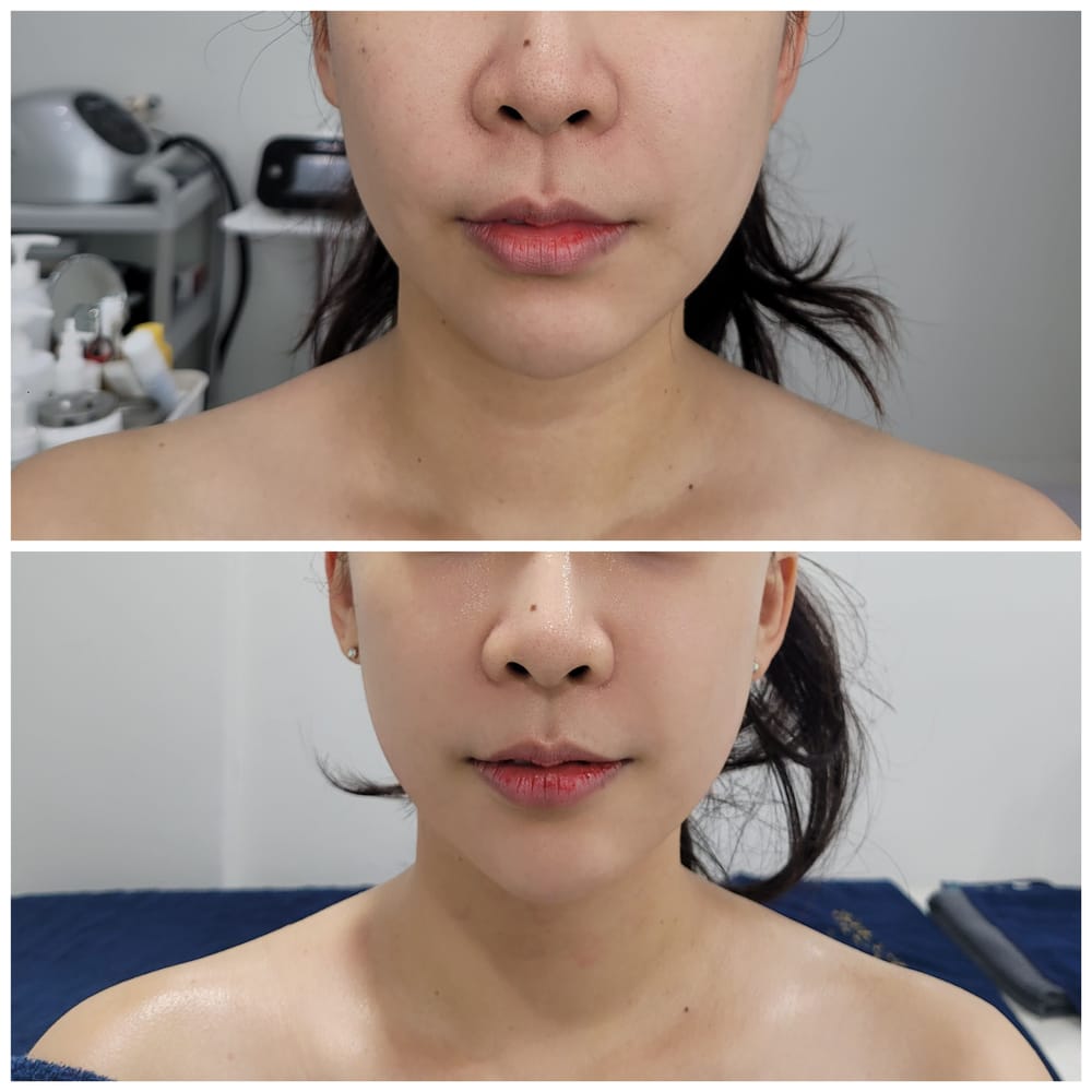 얼굴 관리 전후 비교 사진. 눈 부위는 가려 두었다